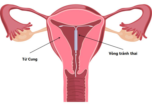 Đặt vòng tránh thai Đặt vòng tránh thai